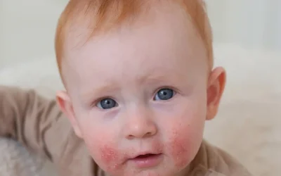 Periorální dermatitida: příčiny, příznaky a účinná péče o podrážděnou pokožku
