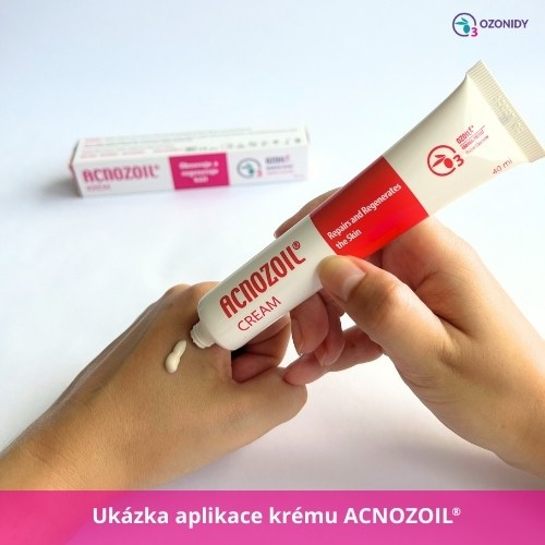 Ukázka aplikace Acnozoil krému na pokožku ruky – produktové balení