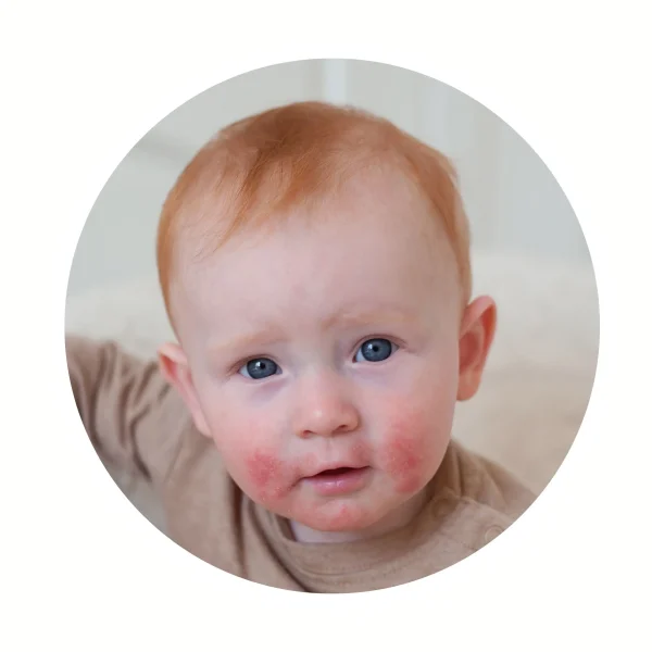 Periorální dermatitida: příčiny, příznaky a&nbsp;účinná péče o&nbsp;podrážděnou pokožku