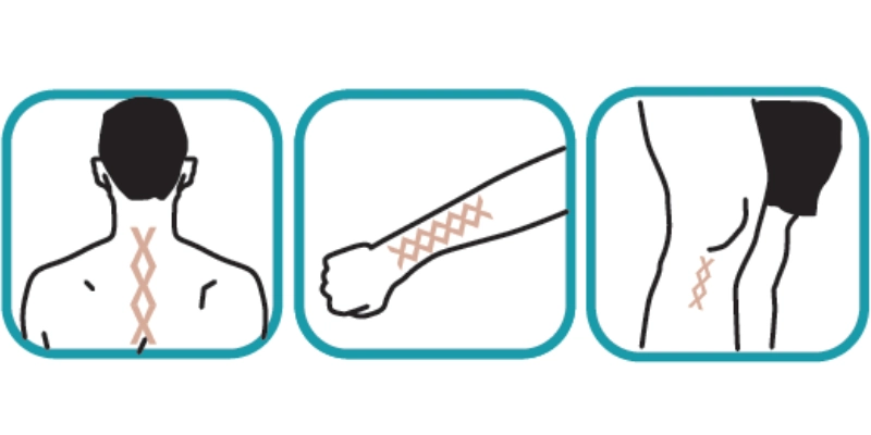 Příklady jak pracovat s tejpovací páskou RIGENOMA proti bolesti, otokům a regeneraci kůže.